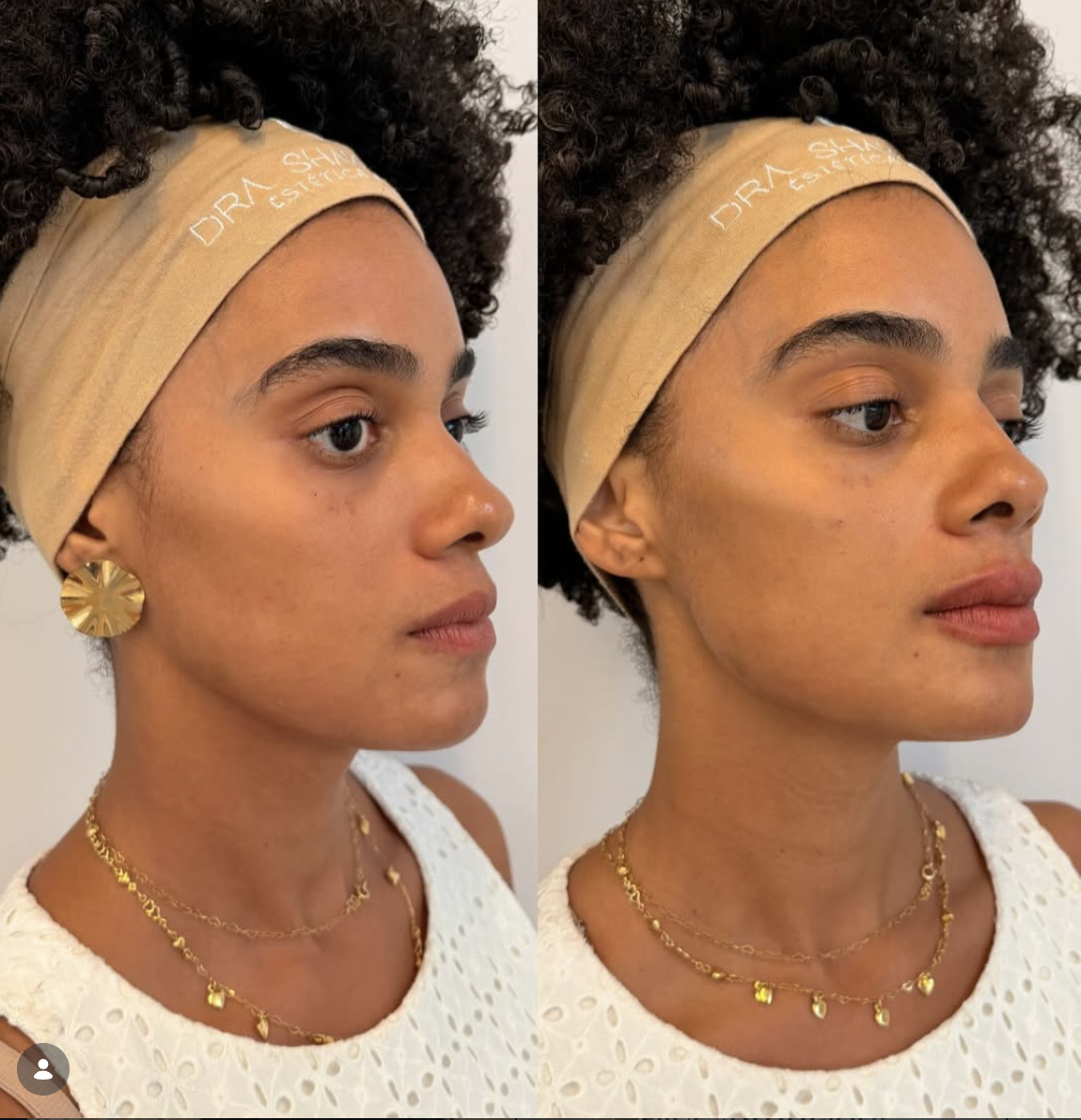 Resultado Harmonização Facial — antes e depois