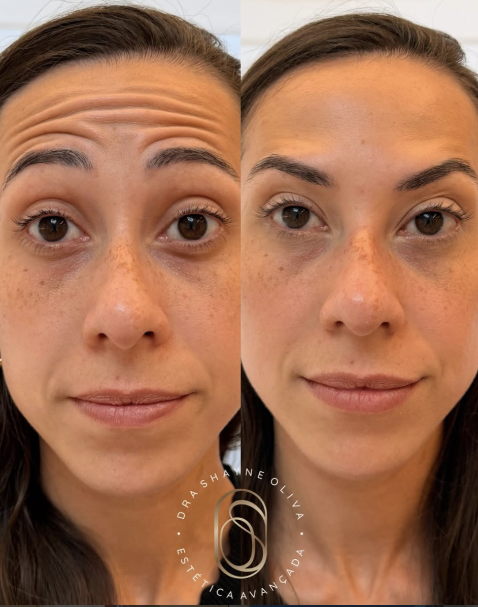 Resultado Toxina Botulínica — antes e depois
