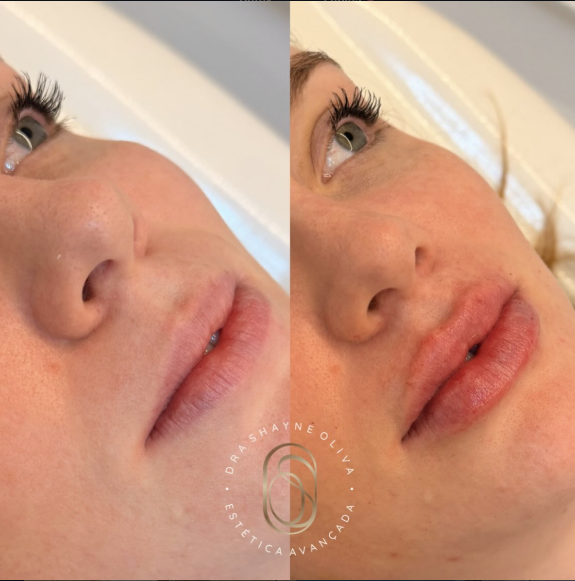 Resultado Preenchimento Labial — antes e depois